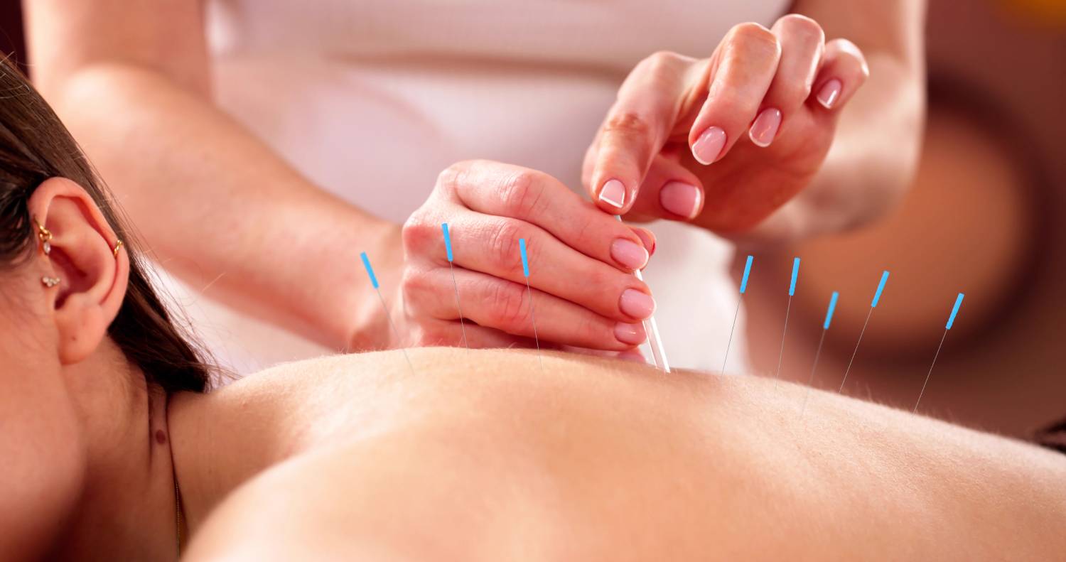 Dry Needling